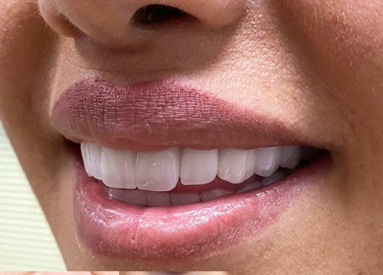 Real Seta Clinic patient smiling after Hollywood Smile veneer treatment