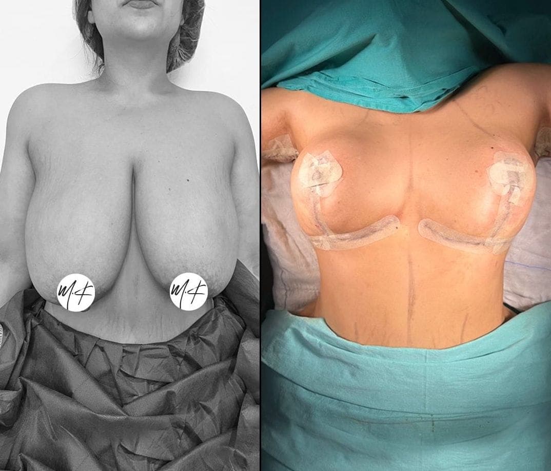 Breast Lift, before and after