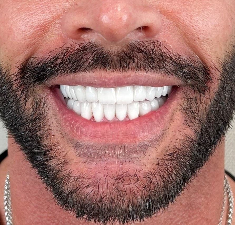 Hollywood Smile after treatment