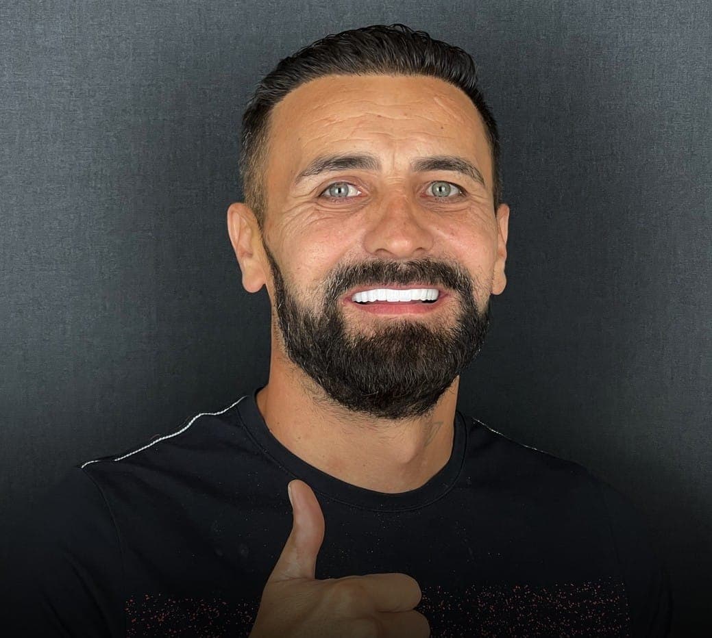 Hollywood Smile, before and after