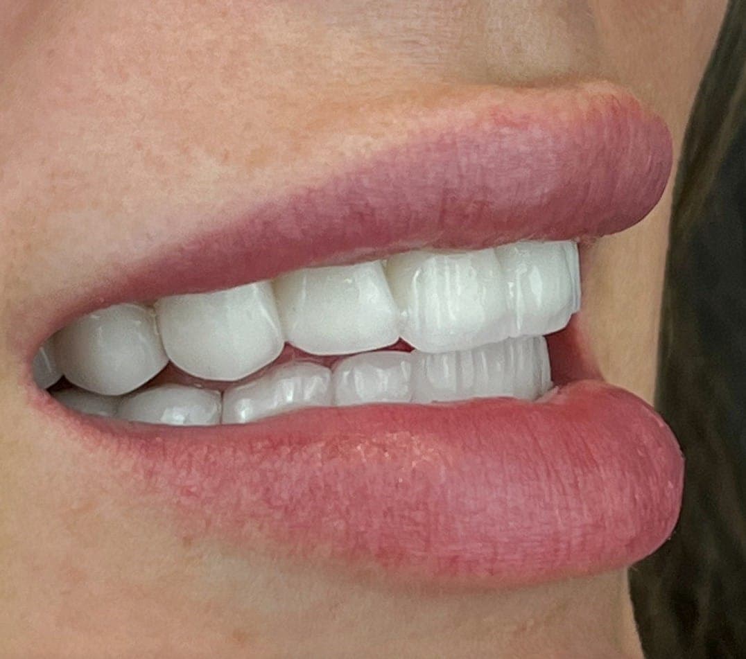 Hollywood Smile, before and after