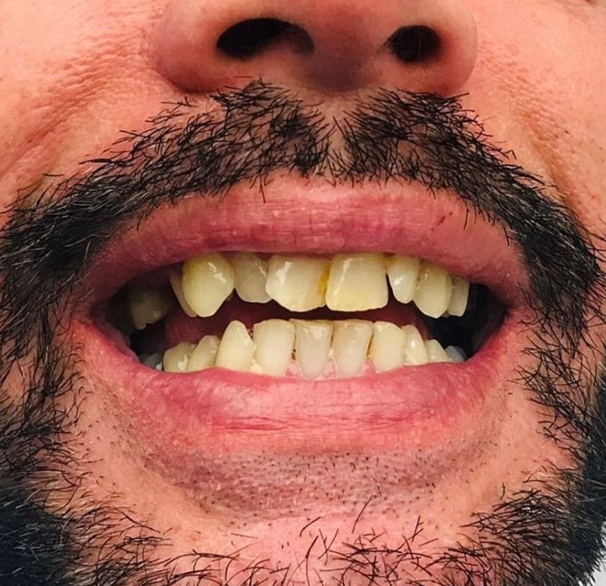 Hollywood Smile before treatment