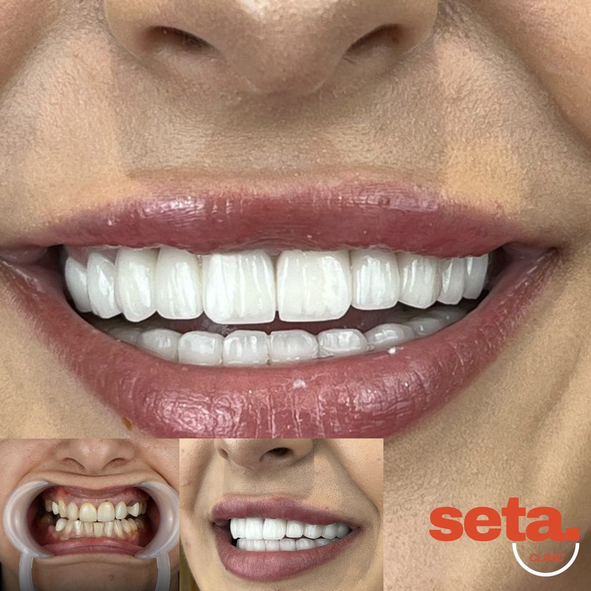 Hollywood Smile, before and after