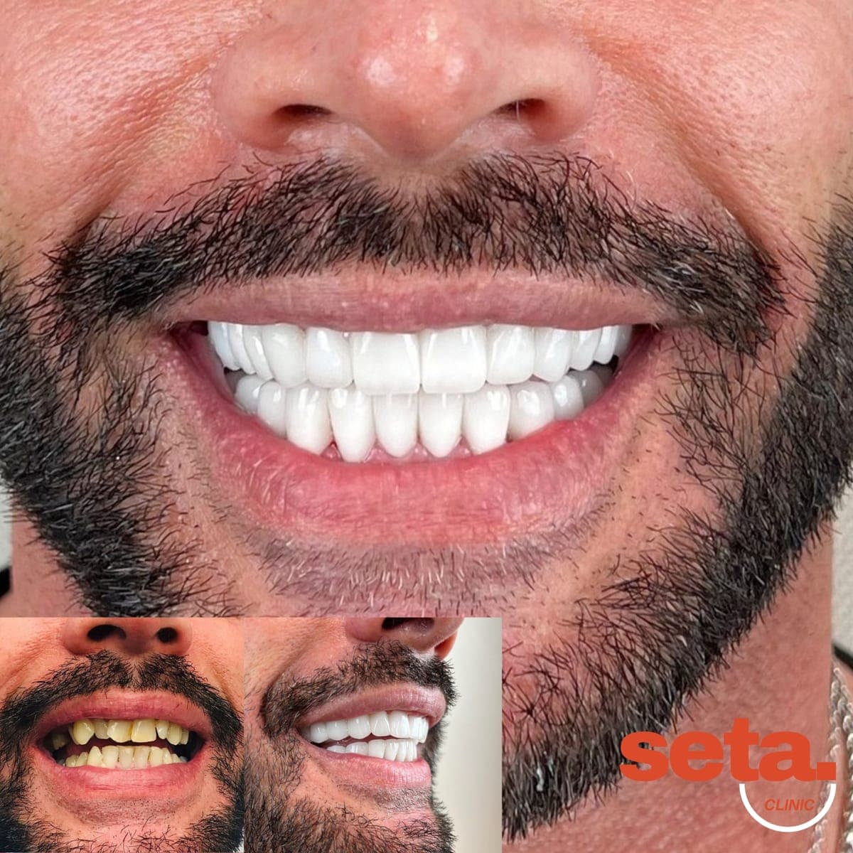 Hollywood Smile, before and after