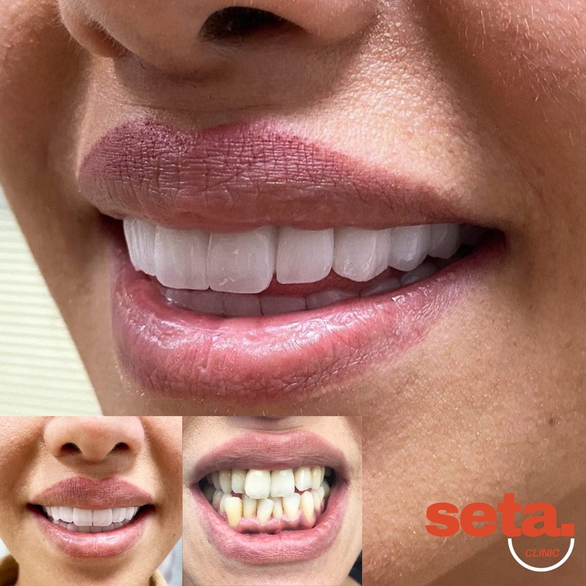 Hollywood Smile, before and after