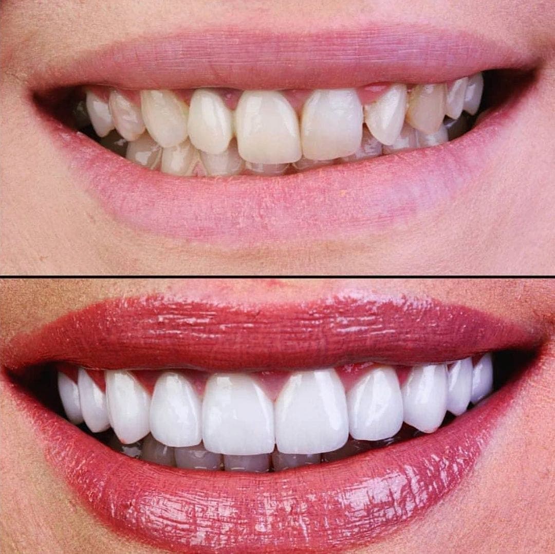 Hollywood Smile, before and after