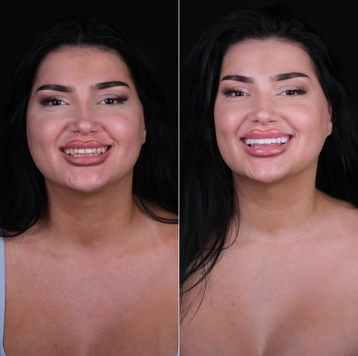 Hollywood Smile, before and after