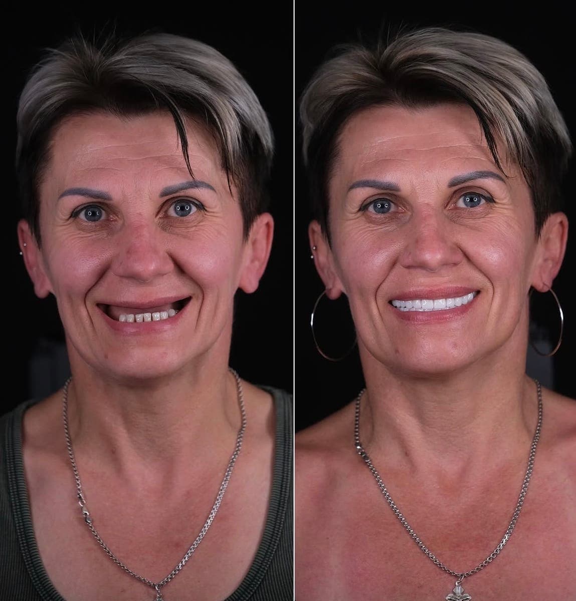 Hollywood Smile, before and after