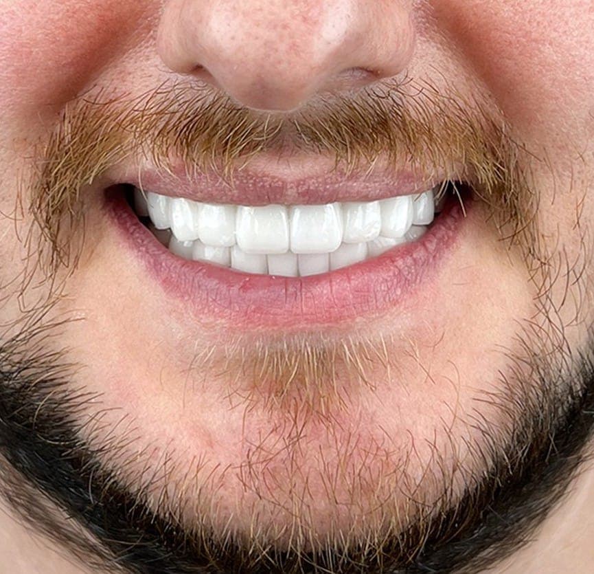 Hollywood Smile after treatment