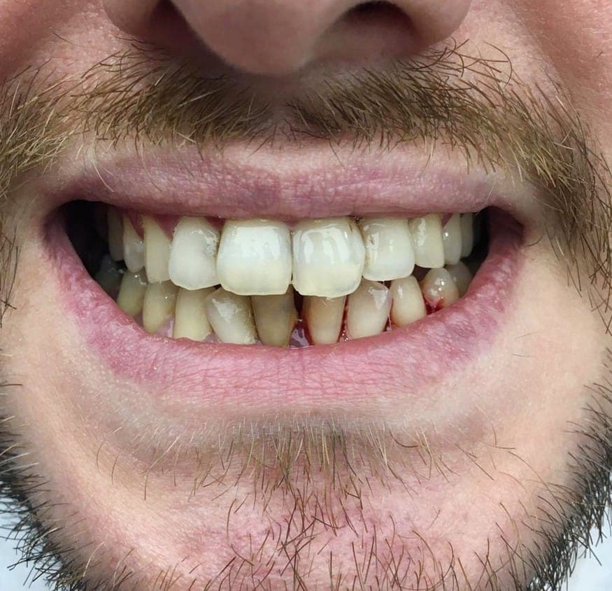 Hollywood Smile before treatment