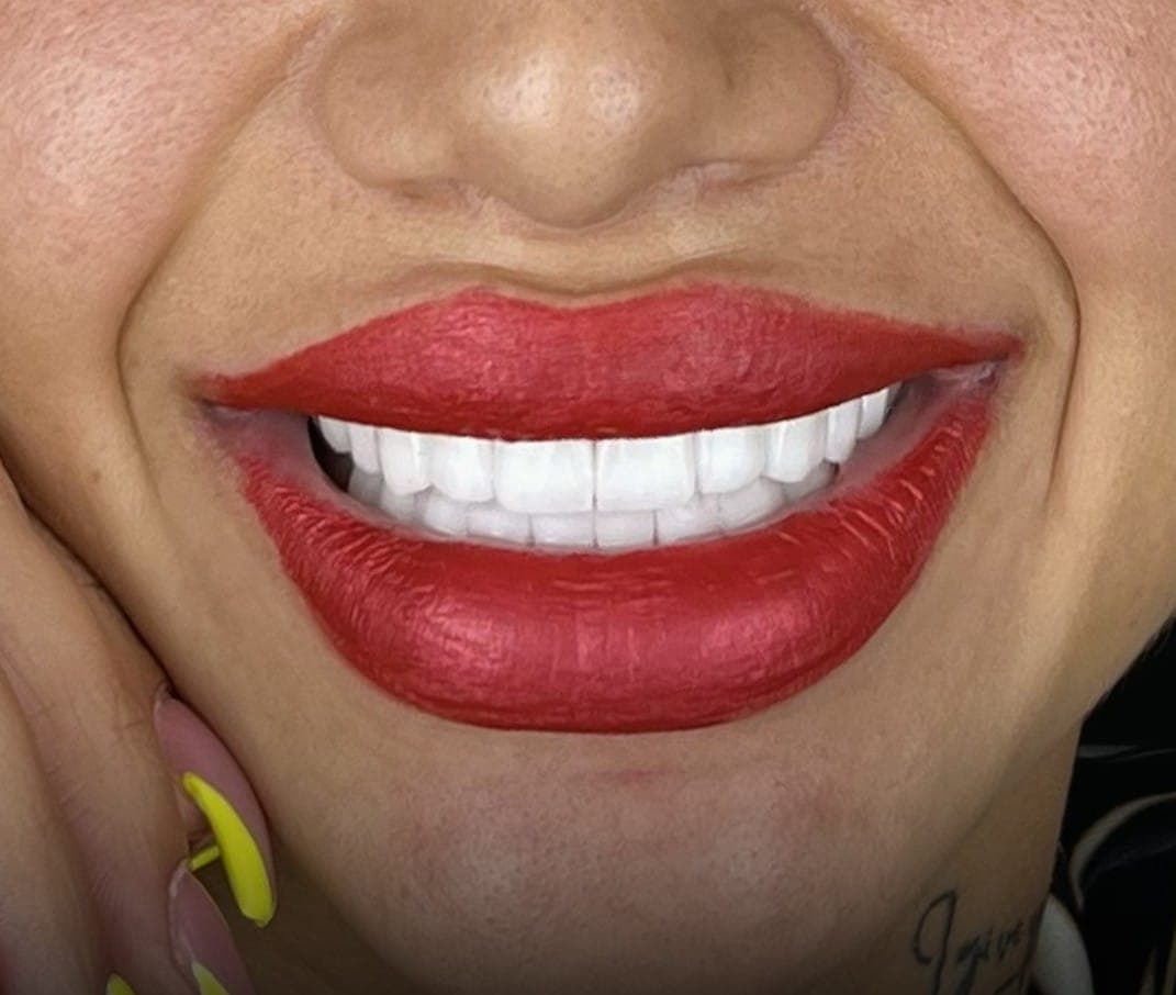 Hollywood Smile after treatment