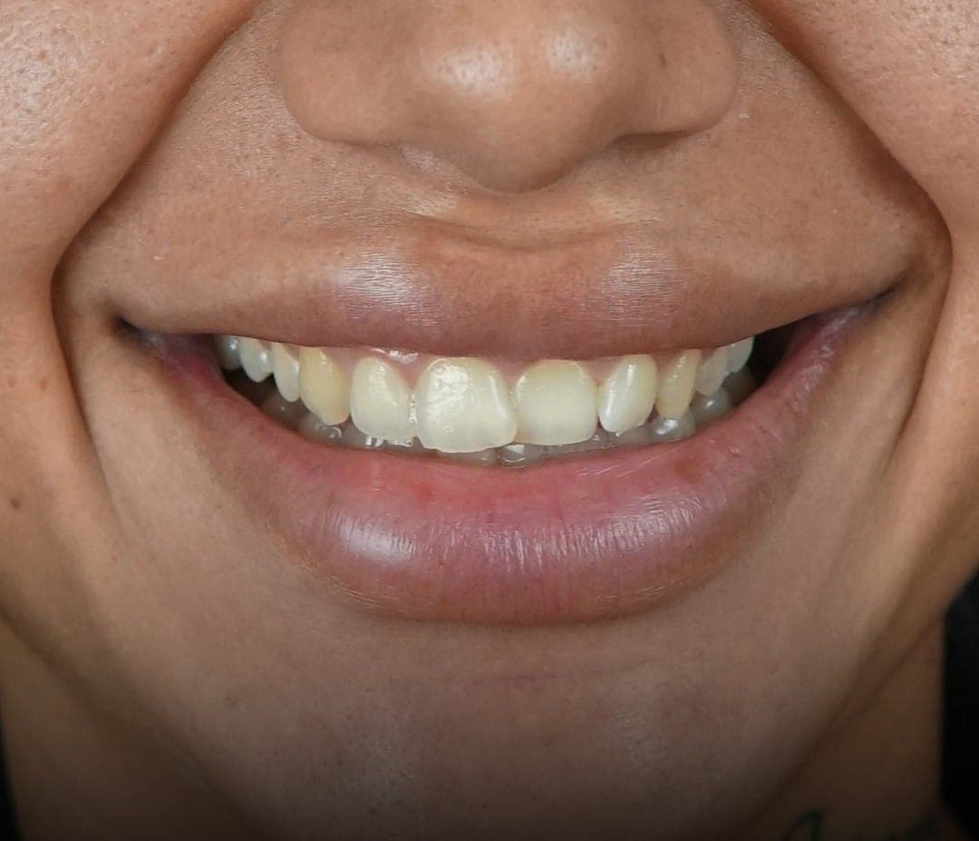 Hollywood Smile before treatment