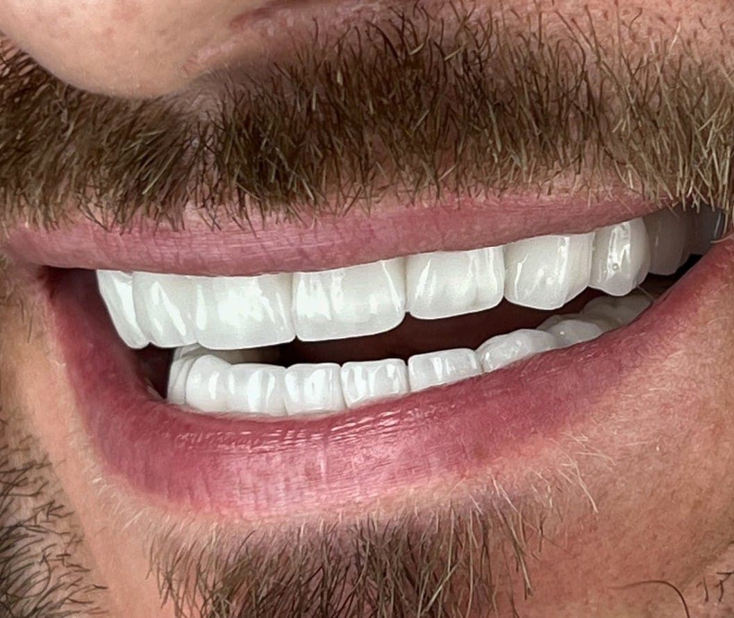Hollywood Smile after treatment