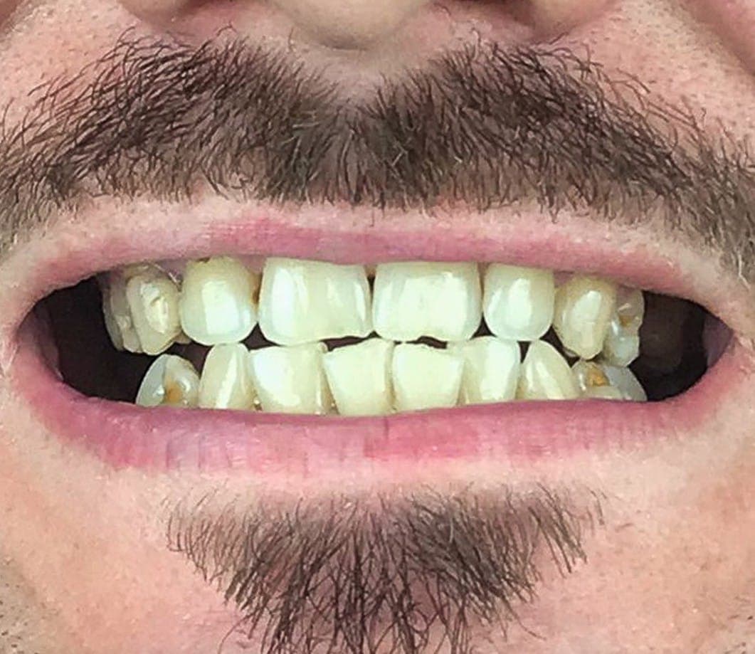 Hollywood Smile before treatment