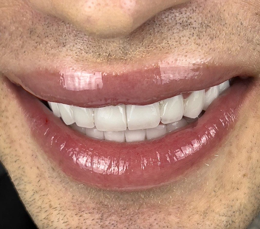 Hollywood Smile after treatment