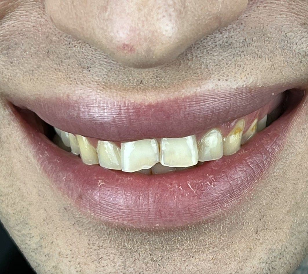Hollywood Smile before treatment