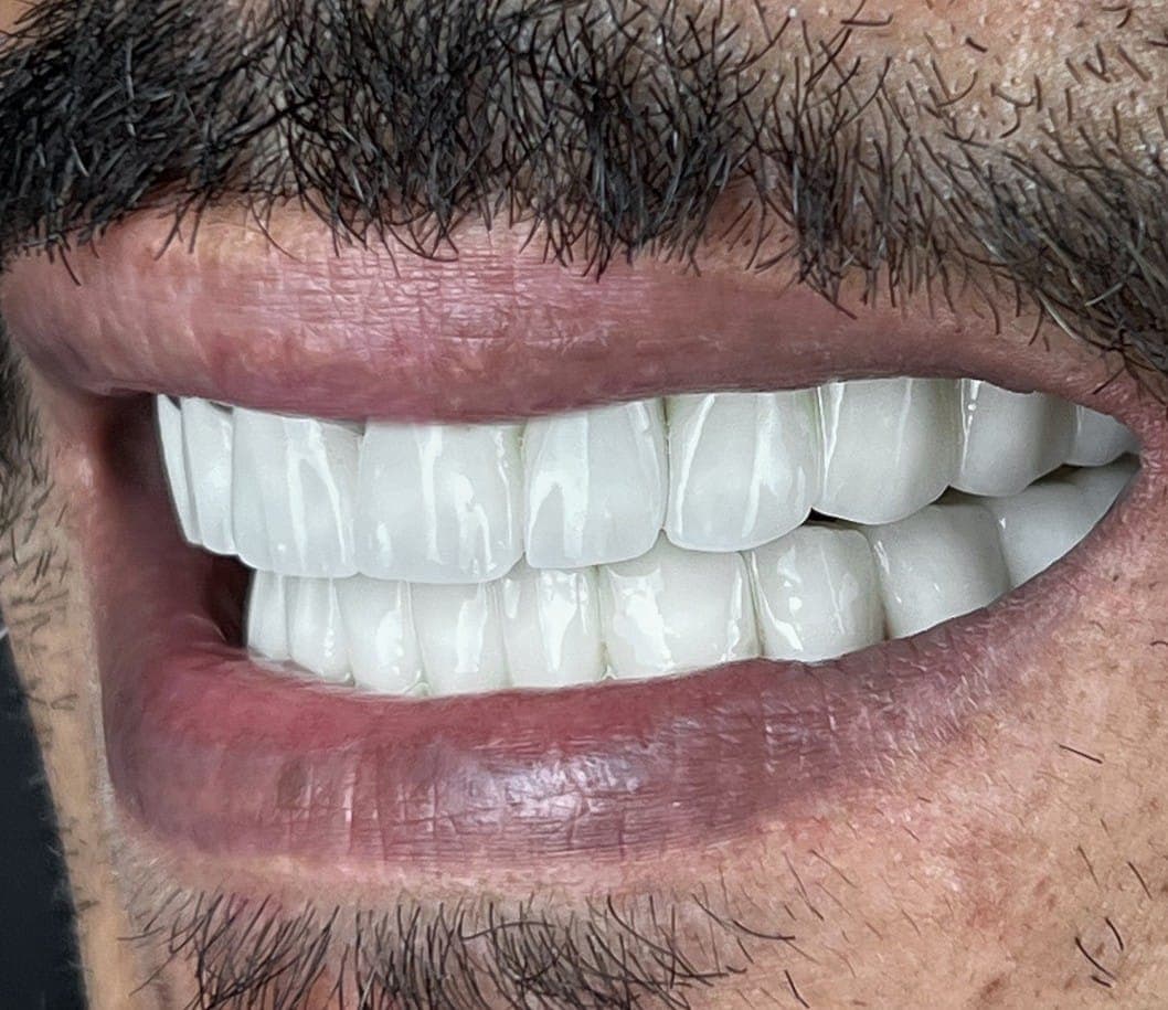 Hollywood Smile after treatment