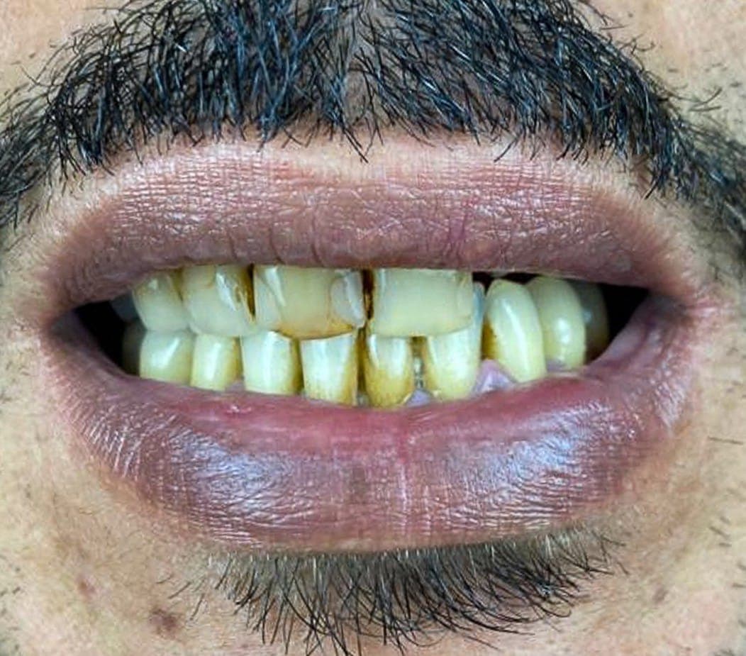 Hollywood Smile before treatment