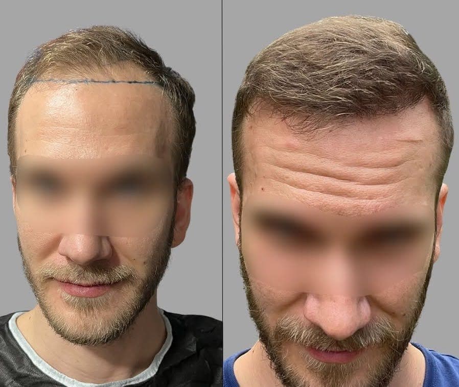 Hair Transplant, before and after