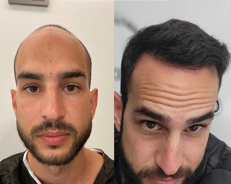 Hair Transplant, before and after