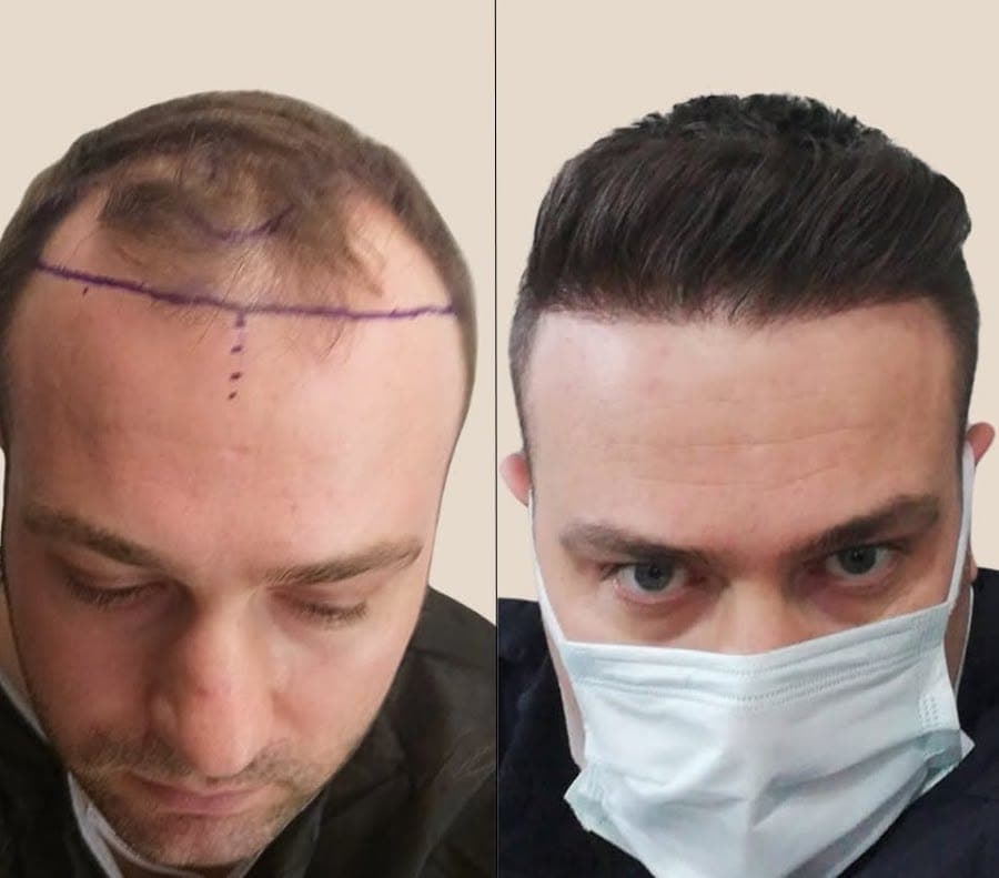 Hair Transplant, before and after