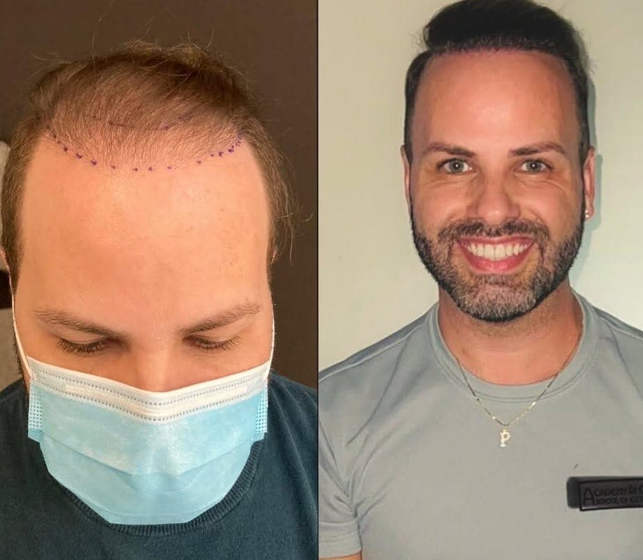 Hair Transplant, before and after