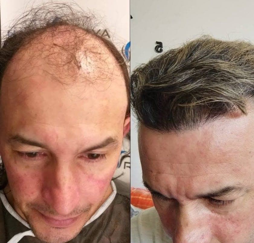 Hair Transplant, before and after