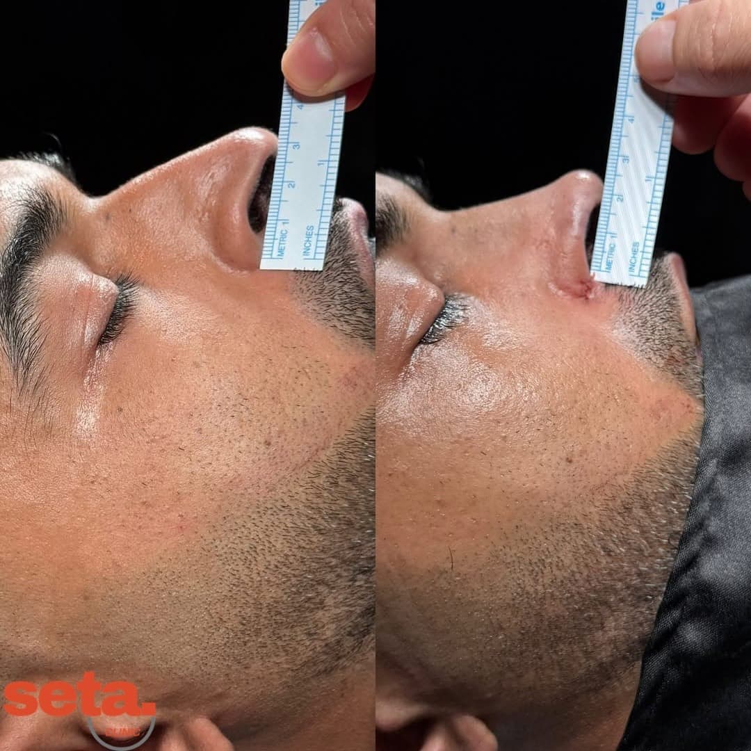 Nasenkorrektur, before and after
