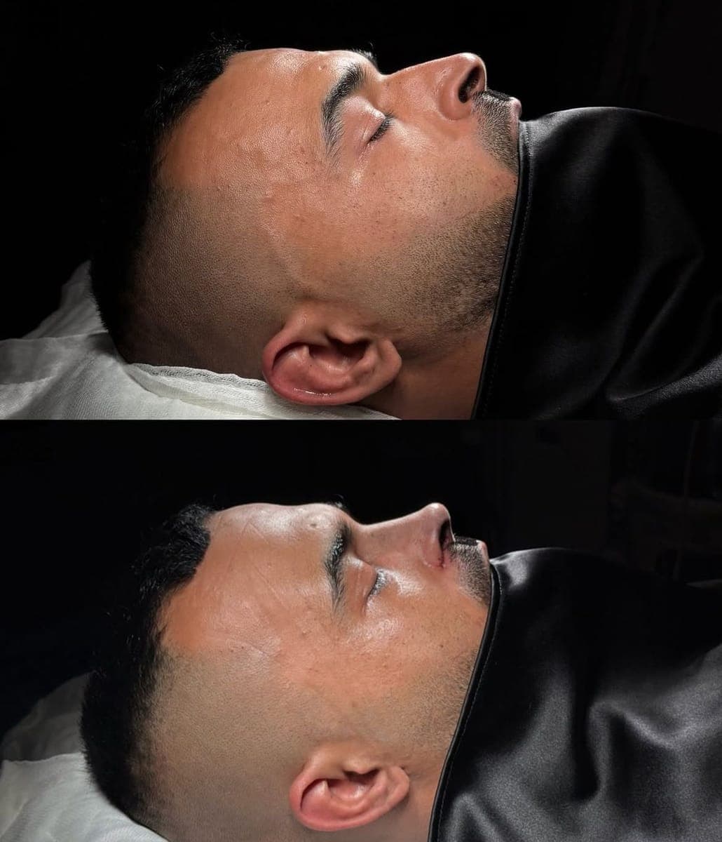 Nasenkorrektur, before and after