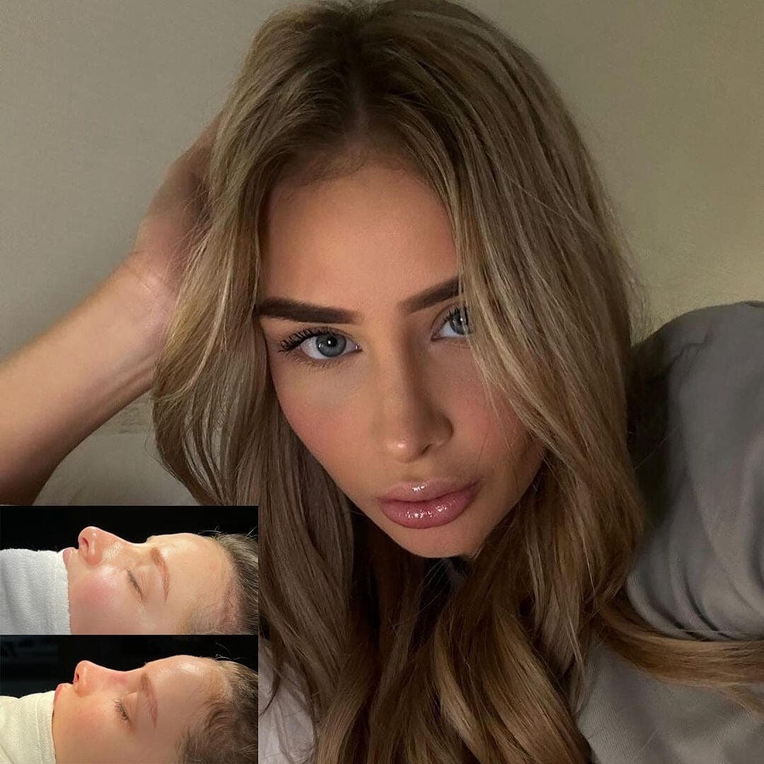Rhinoplasty, before and after