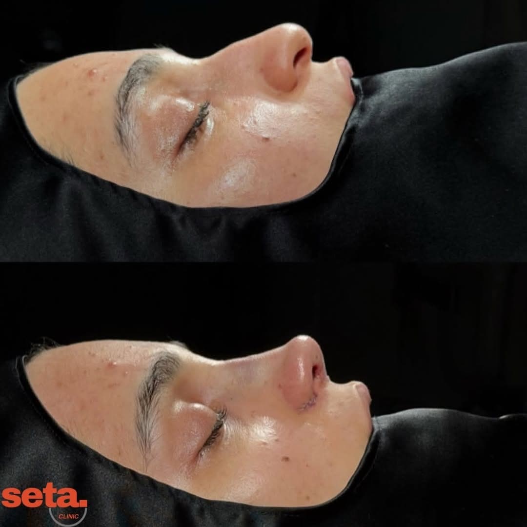 Rhinoplasty, before and after
