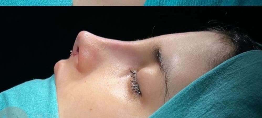 Nasenkorrektur after treatment