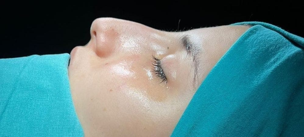 Nasenkorrektur before treatment