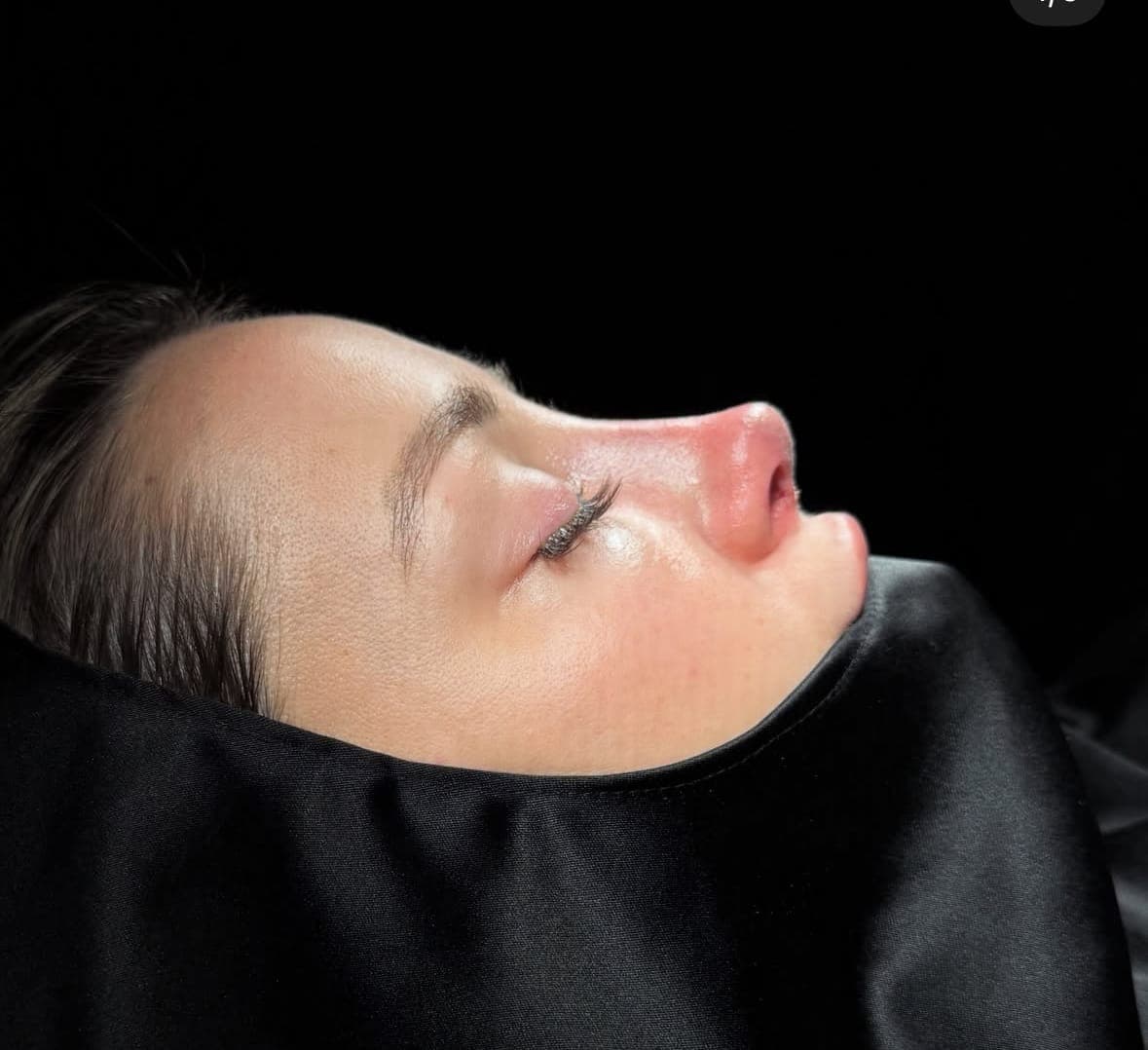 Rhinoplasty, before and after